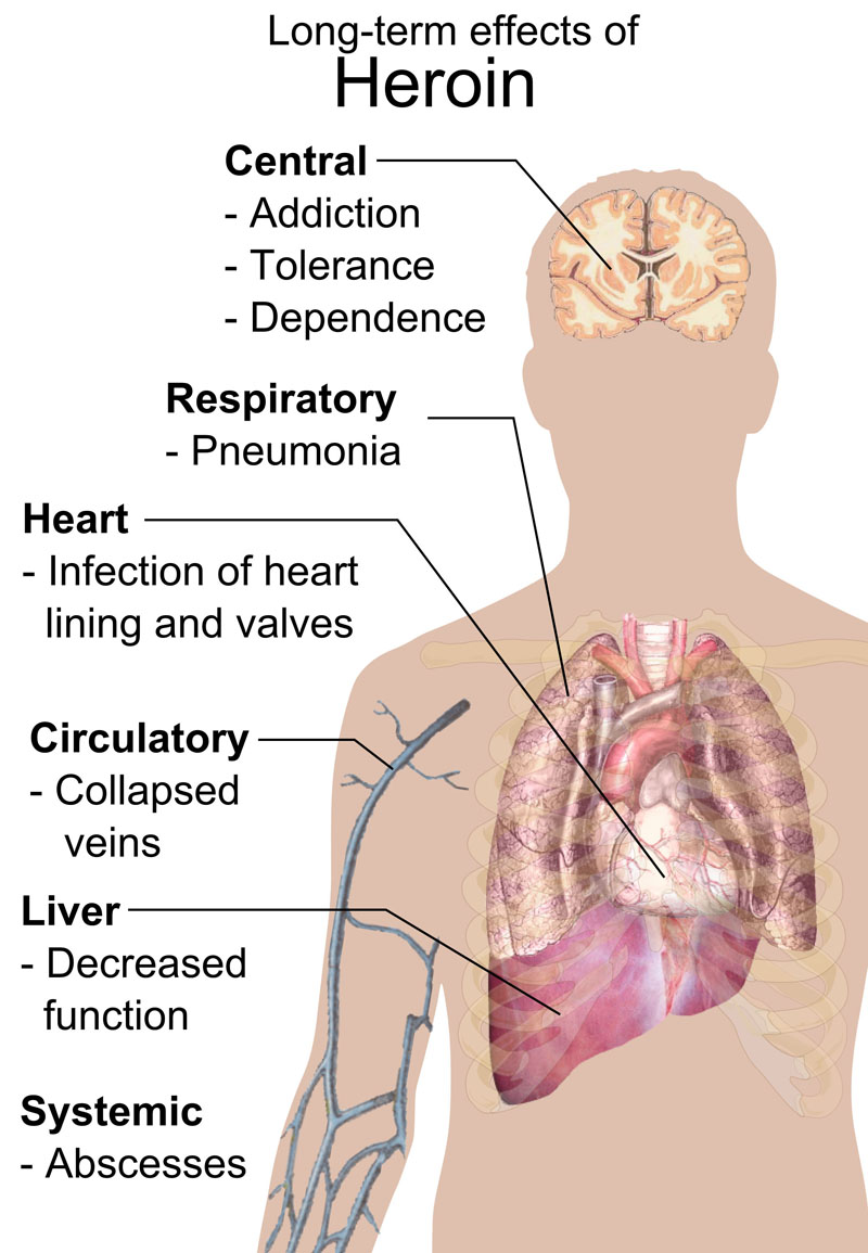 Short-term effects of Heroin