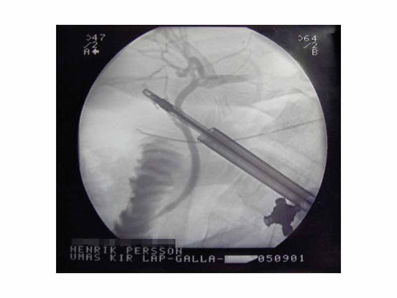 X-ray during Cholecystectomy