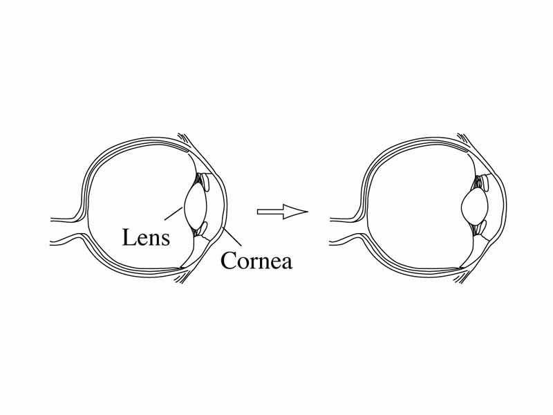 Accomodation in the human eye