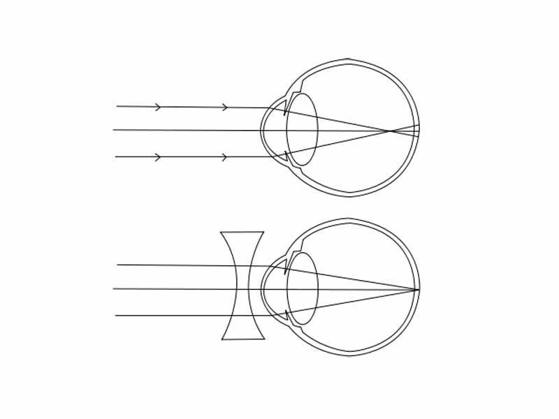 Compensating for myopia using a corrective lens.