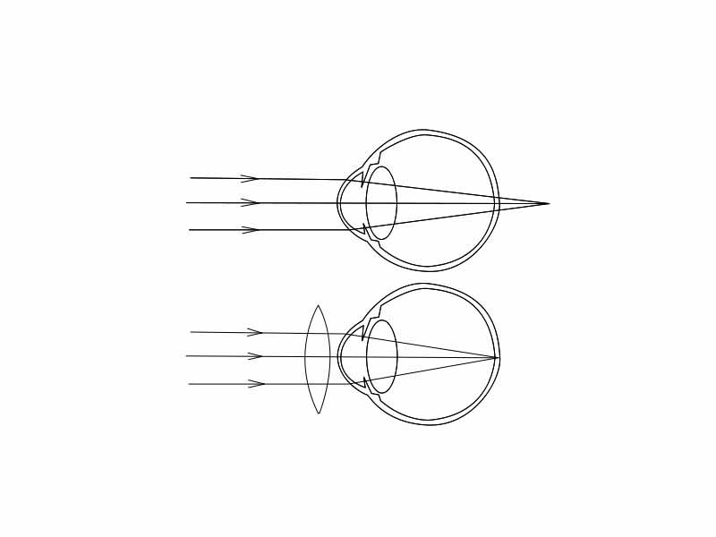 Hyperopia, and restoring of vision with convex lens