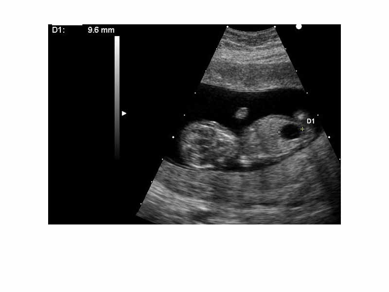 Ultrasound of fetus with Down syndrome and megacystis