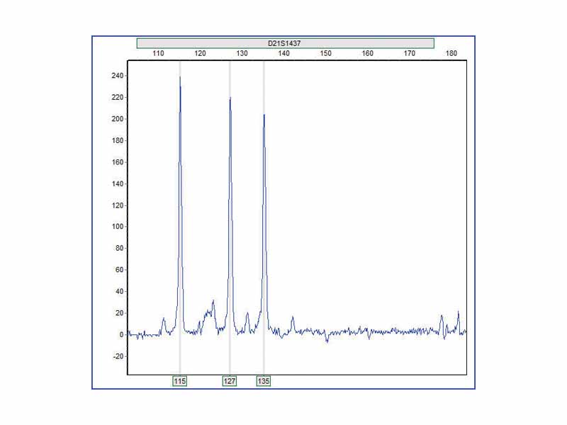 Example of Trisomy 21 Detected via qPCR Short Tandem Repeat assay