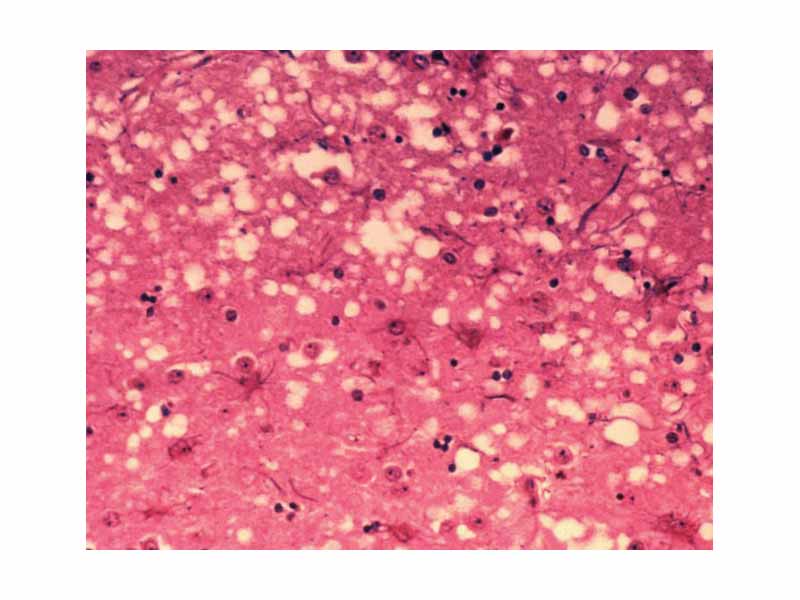 This micrograph of brain tissue reveals the cytoarchitectural histopathologic changes found in bovine spongiform encephalopathy. The presence of vacuoles, i.e. microscopic holes in the gray matter, gives the brain of BSE-affected cows a sponge-like appearance when tissue sections are examined in the lab.