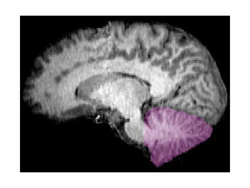 MRI image showing a mid-sagittal view of the human brain, with the cerebellum in purple.