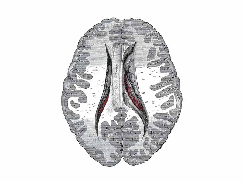 Central part and anterior and posterior cornua of lateral ventricles exposed from above.