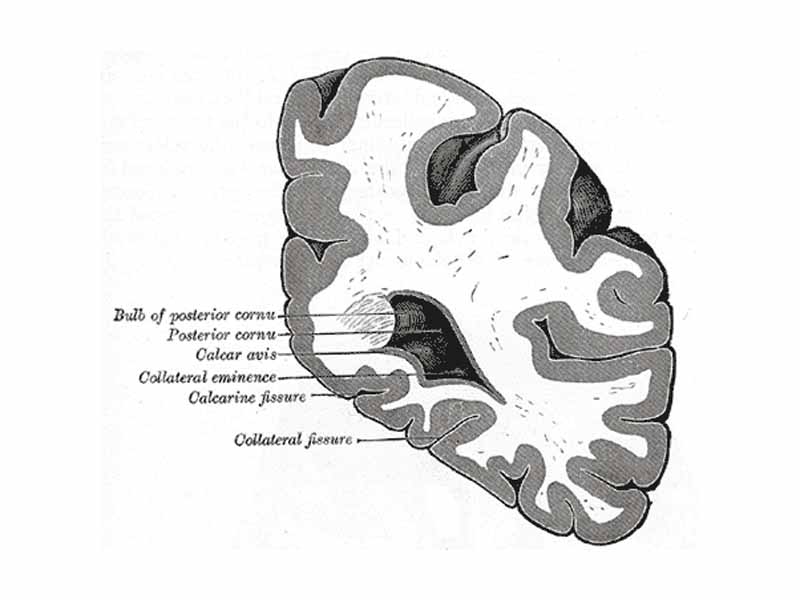 Coronal section through posterior cornua of lateral ventricle.