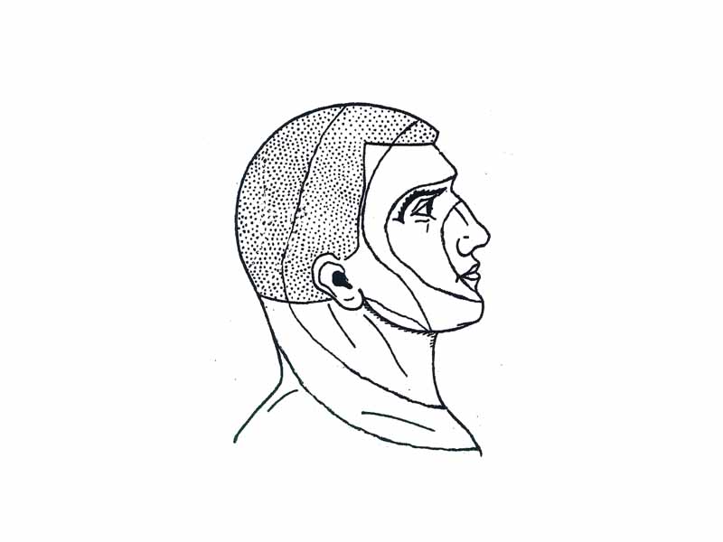 Onion Skin Distribution of the Trigeminal Nerve