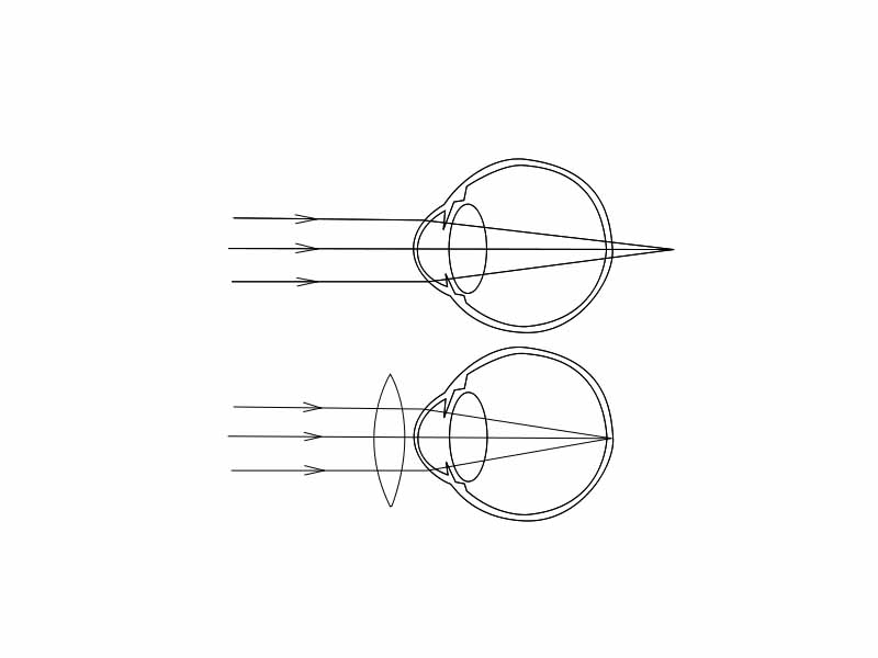 Hyperopia, and restoring of vision with convex lens