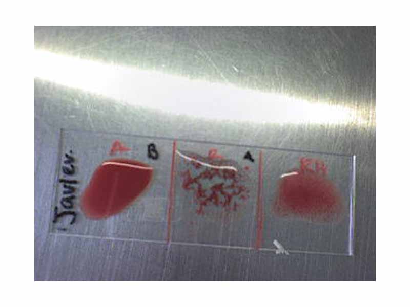 Result: Blood group B negative: anti-A and anti-Rh have not agglutinated but anti-B has