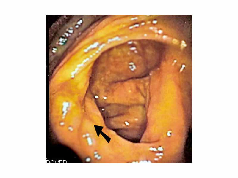 Ileocecal valve