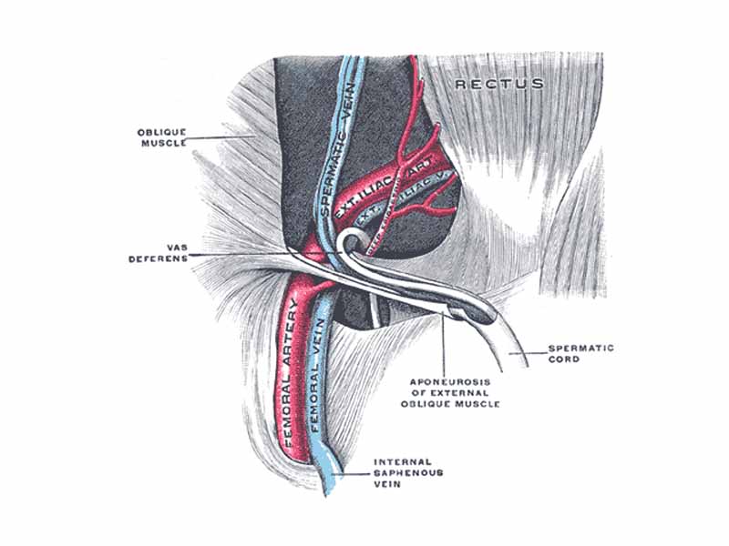 The spermatic cord in the inguinal canal.