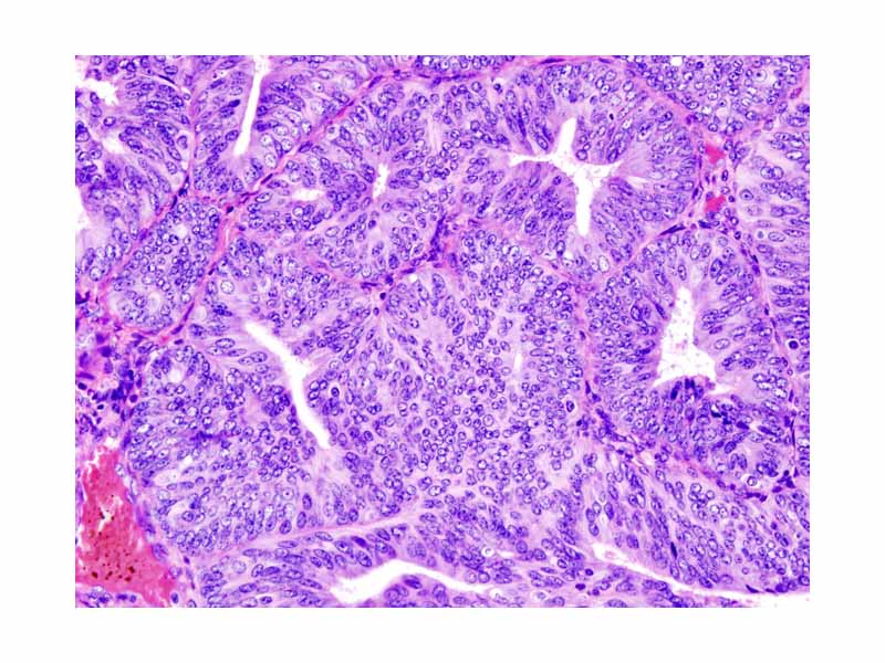 Histopathologic representation of endometrioid adenocarcinoma demonstrated in endometrial biopsy. Hematoxylin-eosin stain.