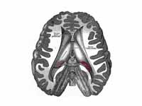 Dissection showing the ventricles of ...