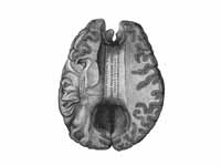 Corpus callosum from above. (Anterior...