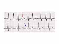 ECG of atrial fibrillation (top) and ...