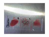 Result: Blood group B negative: anti-...